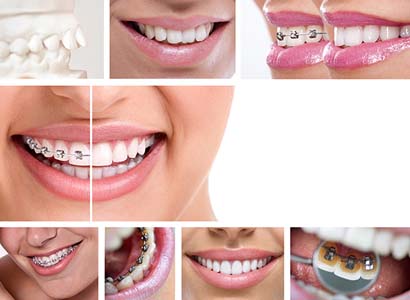 Learn How Braces Can Help To Transform Your Smile