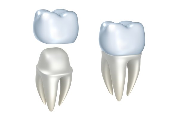 The Various Types Of Dental Crowns