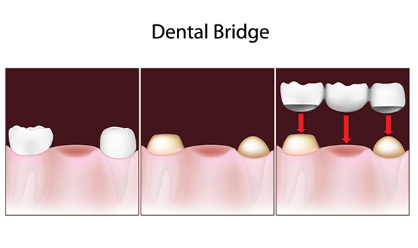 How A Cosmetic Dentist Creates A Dental Bridge