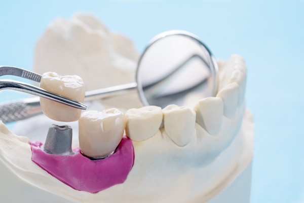 Will I Need A Dental Crown  After A Root Canal?