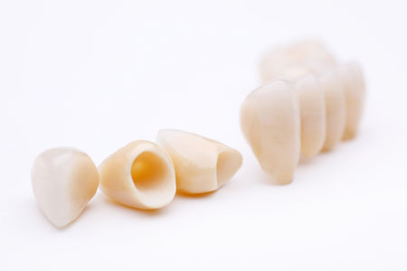 The Facts About Dental Crowns