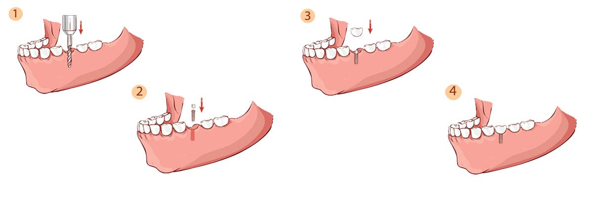 Blaine The Dental Implant Procedure