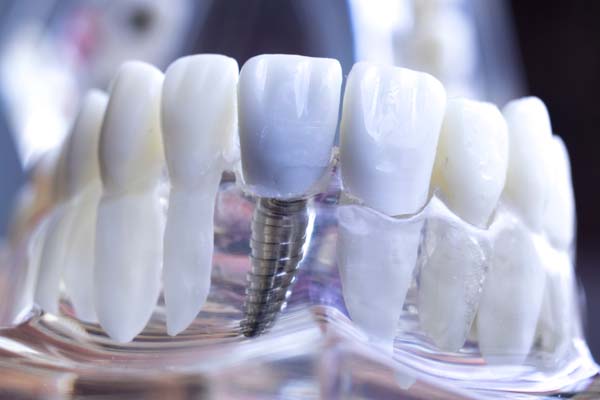 What Is Dental Implant Restoration?