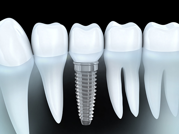 Dental Implants Are A Popular Solution For Tooth Loss