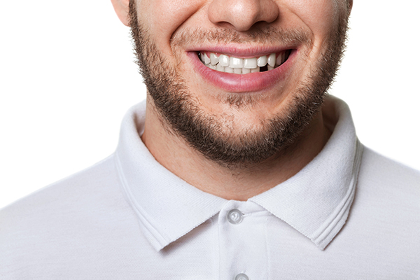 Dental Implants Are A Permanent Alternative To Dentures