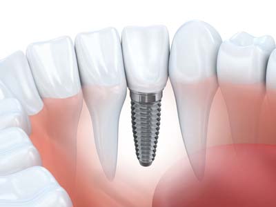 How Dental Implants Are Placed In The Jawbone