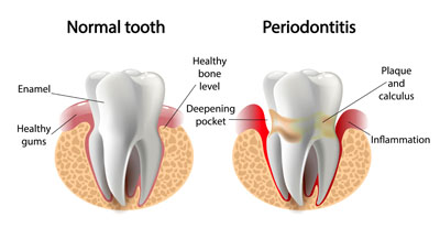 Why Gum Disease Prevention Is Important