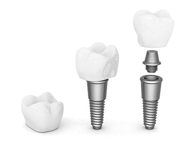 Reasons To Consider Implant Dentistry When Replacing Teeth