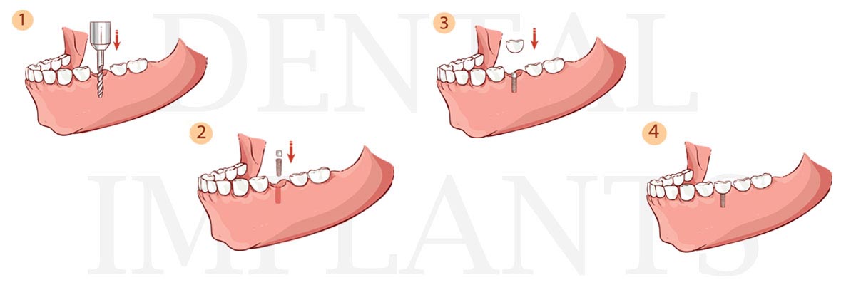 Blaine The Difference Between Dental Implants and Mini Dental Implants