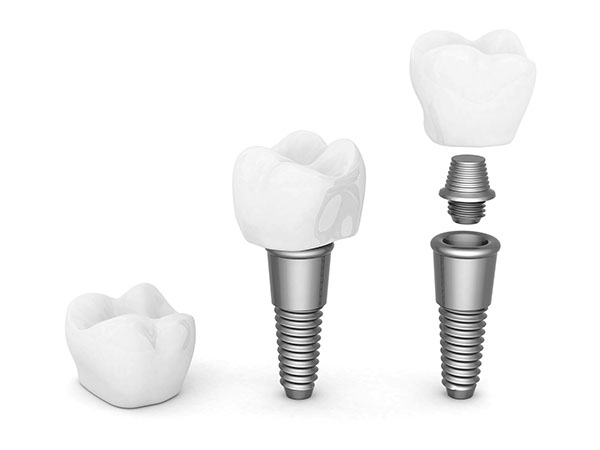 Mini Dental Implants