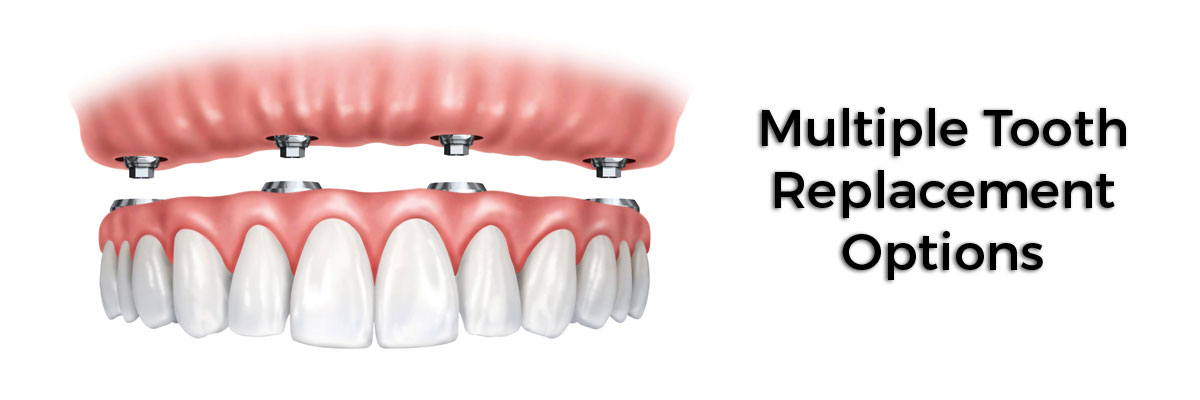 Blaine Multiple Teeth Replacement Options