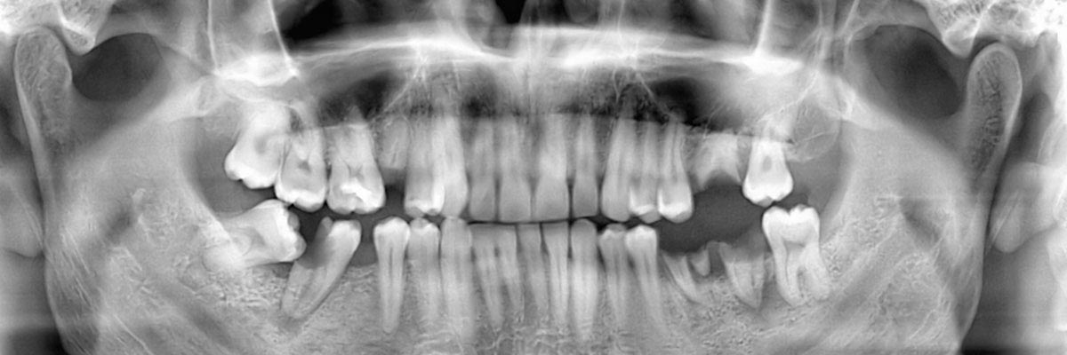 Blaine Options for Replacing Missing Teeth