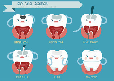 Why You Should Visit Our Blaine Office For A Root Canal