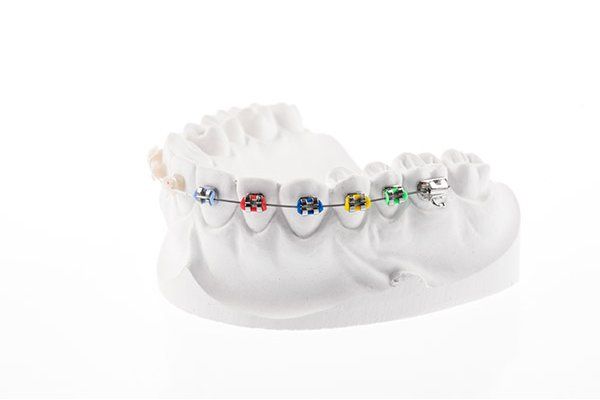 Six Month Braces From Arden Dental Associates Is A Great Adult Orthodontic Treatment