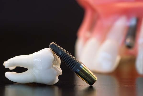 Tooth Implant Blaine, MN